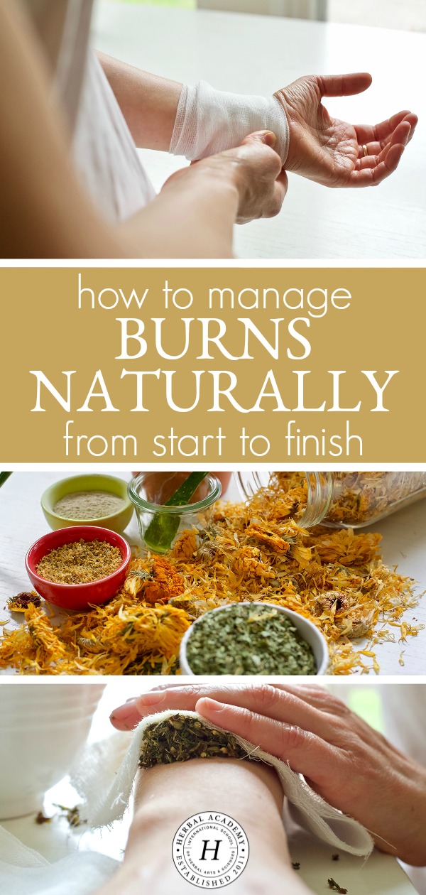 How To Manage Burns Naturally From Start To Finish | Herbal Academy | Burns are a common ailment that many will experience at least once in life. Learn how to manage burns naturally the next time you experience a burn.