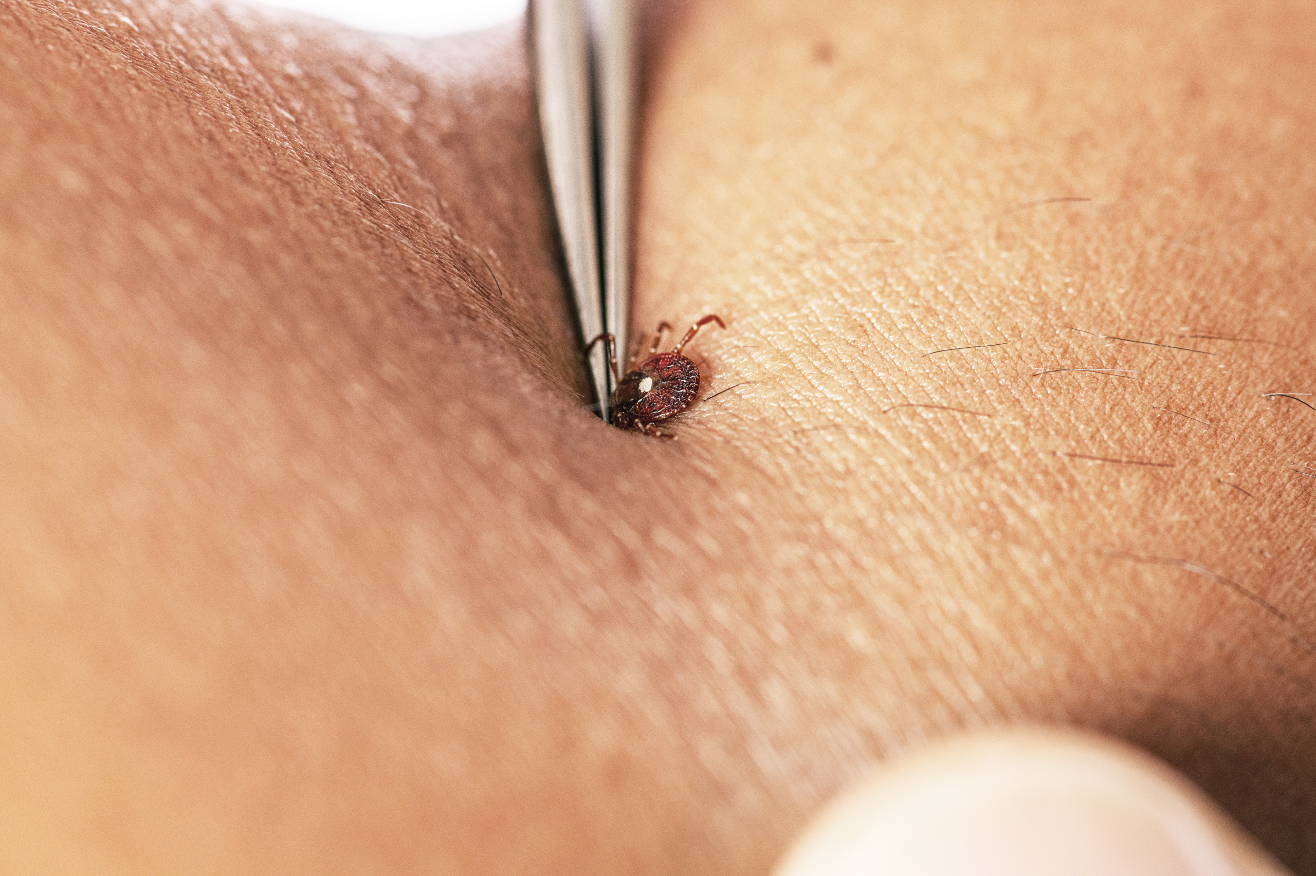 tweezers removing a tick from a person